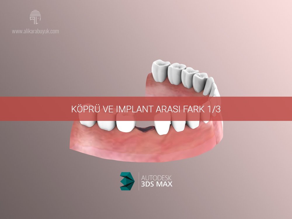3D Implant ve Diş Karşılaştırması 01
