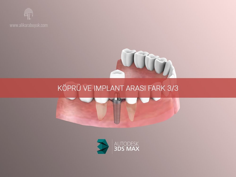 3D Implant ve Diş Karşılaştırması 03